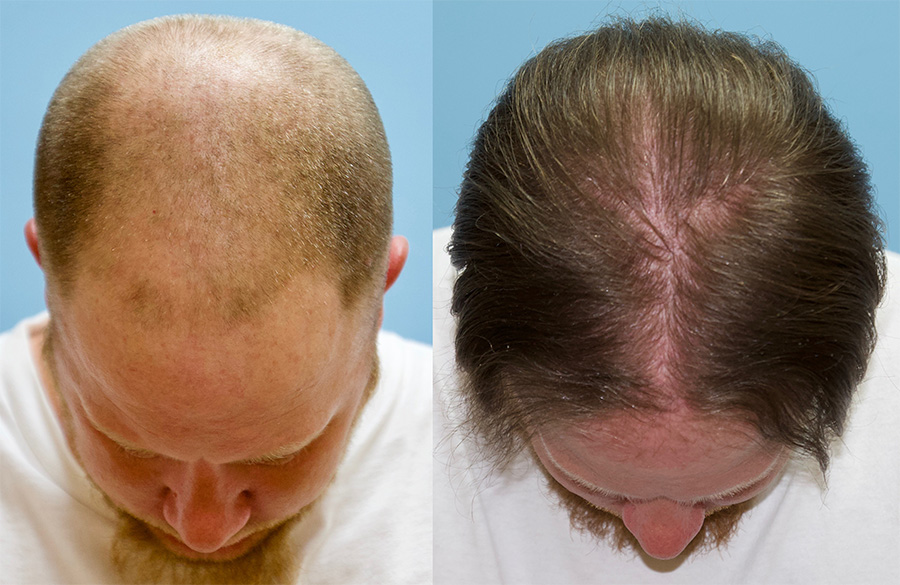 علاج تساقط الشعر الوراثي عند الرجال 