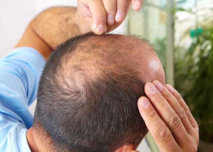وصفات للصلع عند الرجال وأسرار هامة للتخلص من مشكلة الصلع